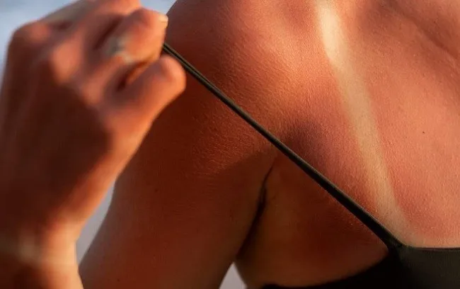 Захист від опіків: рекомендації та перша допомога