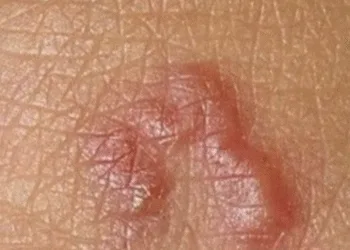 У Рівненській області зафіксували другий випадок підшкірного дирофіляріозу у цьому році